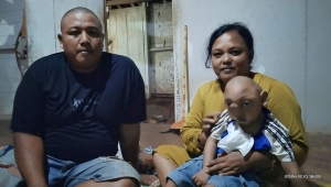 Balita penderita tumor di Lampung Timur